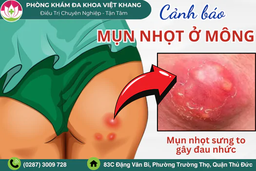 mun-nhot-o-mong-co-nguy-hiem-khong-cach-dieu-tri-nhanh-1743