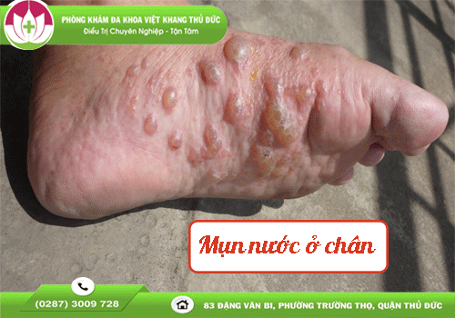 noi-mun-nuoc-chan-do-dau-cach-cham-soc-va-dieu-tri-an-toan-1761