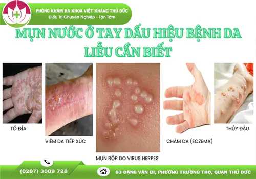 mun-nuoc-o-tay-la-benh-gi-co-nguy-hiem-khong-2146