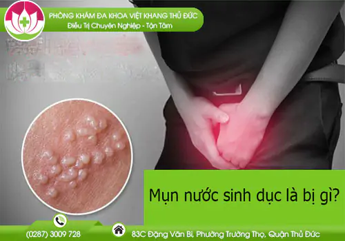 mun-nuoc-sinh-duc-la-bi-gi-khong-nen-chu-quan-781