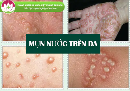 mun-nuoc-tren-da-nhung-dieu-ban-can-biet-va-cach-xu-ly-dung-2144