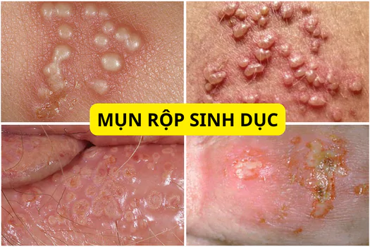 mun-rop-sinh-duc-la-gi-thong-tin-quan-trong-khi-chua-tri-can-luu-y-1272