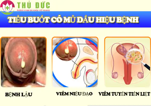 Nam giới cẩn trọng với biểu hiện tiểu buốt có mủ - Dấu hiệu bệnh lý