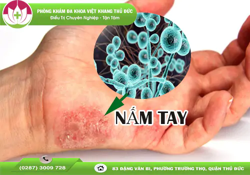 nam-tay-nguyen-nhan-dau-hieu-va-cach-dieu-tri-1893