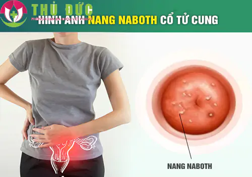 nang-naboth-dau-hieu-nhan-biet-va-cach-dieu-tri-hieu-qua-1239