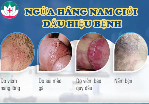 Ngứa háng nam giới biểu hiện bệnh lý nguy hiểm