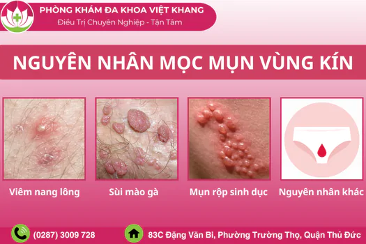 nguyen-nhan-moc-mun-vung-kin-cach-chua-tri-1309