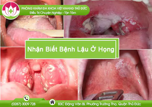 benh-lau-o-hong-nhan-biet-nhu-the-nao-nguy-hiem-ra-sao-1052
