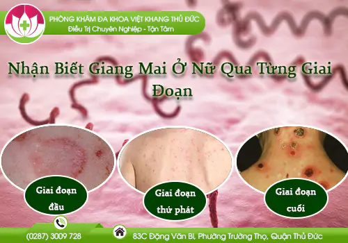 nhan-biet-giang-mai-o-nu-qua-tung-giai-doan-1041