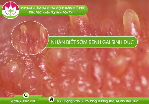 nhan-biet-som-benh-gai-sinh-duc-701