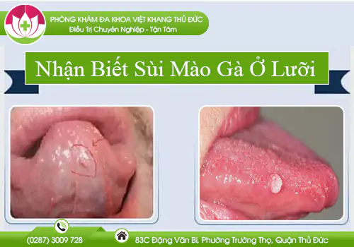 nhan-biet-sui-mao-ga-o-luoi-859