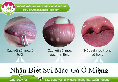 nhan-biet-sui-mao-ga-o-mieng-830