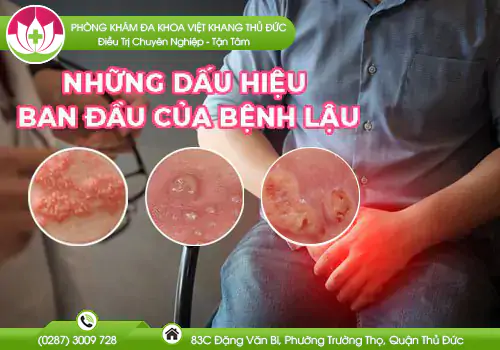 nhung-bieu-hien-ban-dau-cua-benh-lau-696