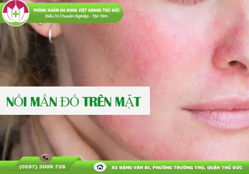 noi-man-do-tren-mat-dau-hieu-canh-bao-suc-khoe-can-luu-y-2032