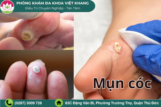 nguyen-nhan-noi-mun-coc-dau-hieu-va-cach-chua-tri-1783
