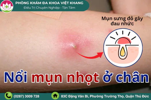 noi-mun-nhot-o-chan-cach-dieu-tri-an-toan-hieu-qua-1824