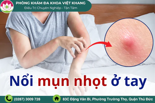 noi-mun-nhot-o-tay-dieu-tri-nhu-the-nao-la-dung-1823
