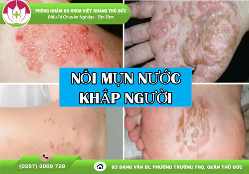 noi-mun-nuoc-khap-nguoi-canh-bao-benh-ly-nguy-hiem-2154