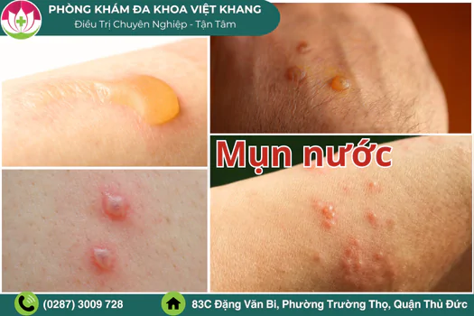 noi-mun-nuoc-khong-ngua-la-benh-gi-1846