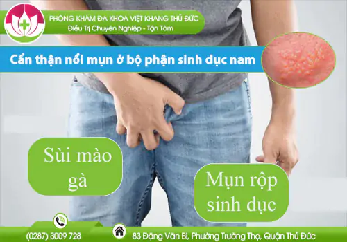 can-than-noi-mun-o-bo-phan-sinh-duc-nam-760