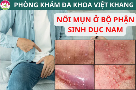 noi-mun-o-bo-phan-sinh-duc-nam-nguyen-nhan-va-cach-dieu-tri-don-gian-1278