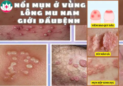 Nổi mụn ở vùng lông mu nam giới dấu hiệu nguy hiểm