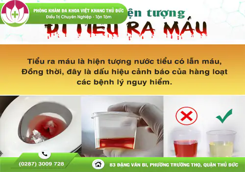 nuoc-tieu-co-mau-la-benh-gi-dung-chu-quan-voi-trieu-chung-nay-2178