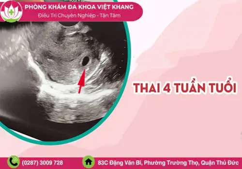 pha-thai-4-tuan-dieu-can-biet-truoc-khi-quyet-dinh-1987
