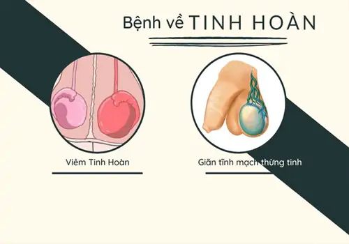 Bệnh tinh hoàn cũng thuộc top các bệnh lý nam khoa nguy hiểm thường gặp