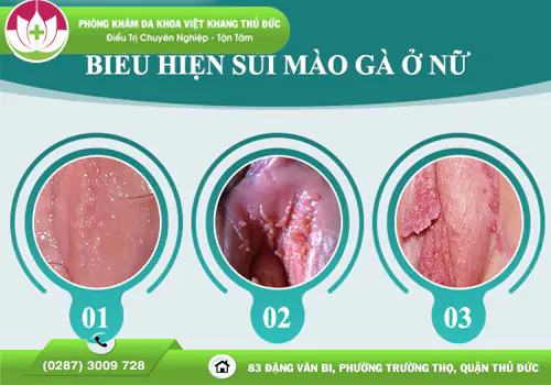 sui-mao-ga-am-dao-trieu-chung-tac-hai-va-cach-dieu-tri-2186