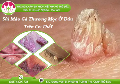 sui-mao-ga-thuong-moc-o-dau-tren-co-the-1074