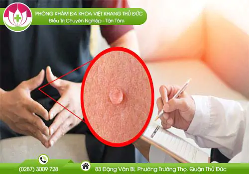benh-sui-mao-ga-co-the-gay-ra-nhung-dang-ung-thu-gi-35