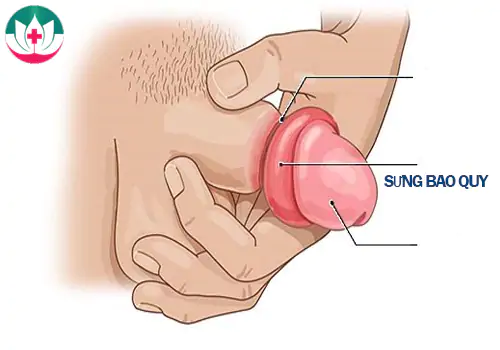 sung-bao-quy-dau-phai-lam-sao-va-cach-khac-phuc-1192