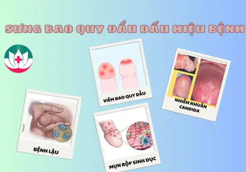 Sưng bao quy đầu dấu hiệu bệnh lý
