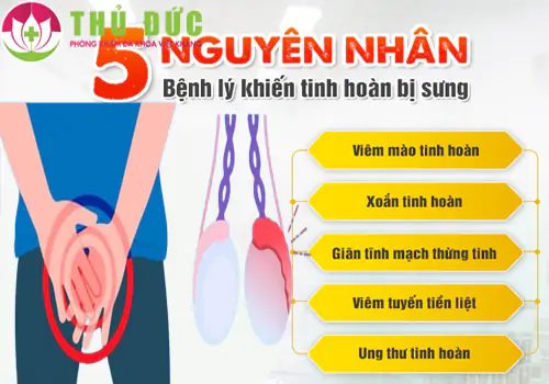 sung-tinh-hoan-dau-hieu-benh-ly-nam-gioi-can-biet-1174