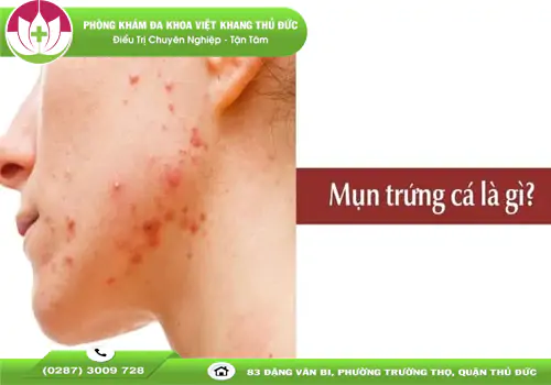 tat-tan-tat-ve-mun-trung-ca-dau-hieu-nhan-biet-va-cach-khac-phuc-1896