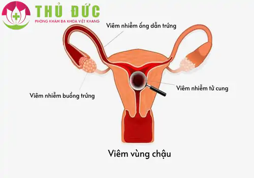 Ra máu âm đạo dấu hiệu cảnh báo bệnh viêm vùng chậu
