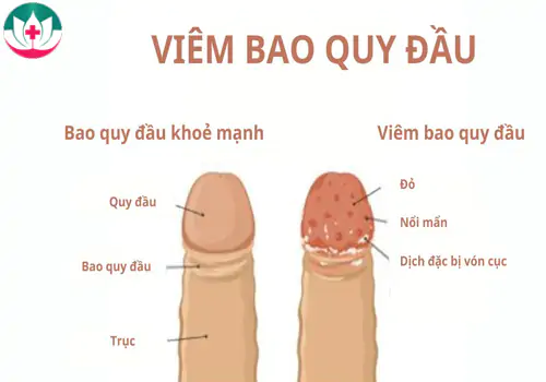 Hình ảnh bệnh viêm bao quy đầu nam giới cần biết