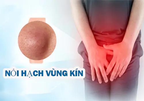 tim-hieu-bi-noi-hach-vung-kin-la-benh-gi-1283