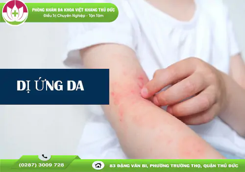 tong-hop-cac-loai-di-ung-da-pho-bien-dau-hieu-va-cach-phong-tranh-2131