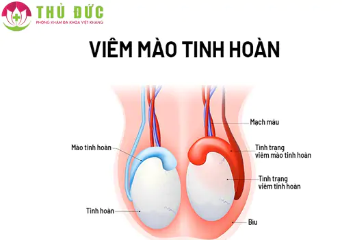 Viêm mào tinh hoàn một trong những bệnh tinh hoàn thường gặp