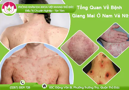 tong-quan-ve-benh-giang-mai-o-nam-va-nu-1047