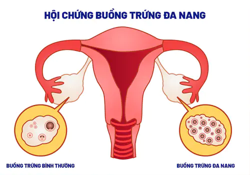 Trễ kinh do nguyên nhân bệnh lý
