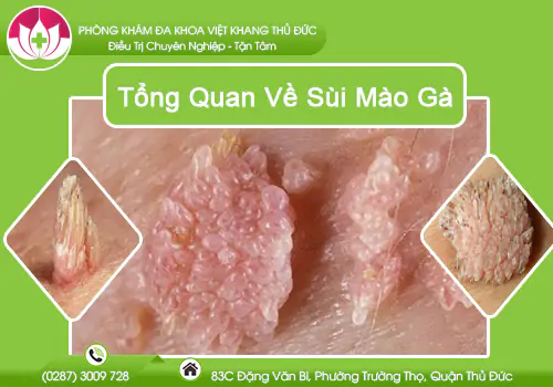 tong-quan-ve-sui-mao-ga-va-cach-dieu-tri-1053