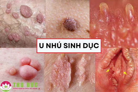 u-nhu-sinh-duc-nguyen-nhan-la-do-dau-cach-dieu-tri-hieu-qua-1182