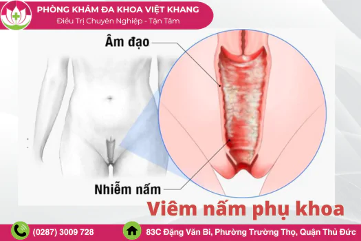 viem-nam-phu-khoa-la-gi-trieu-chung-va-cach-khac-phuc-1552
