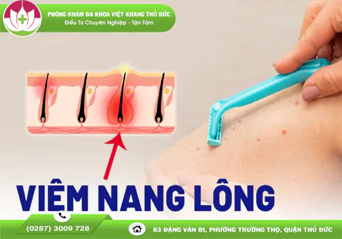 viem-nang-long-nhung-dieu-can-biet-1837