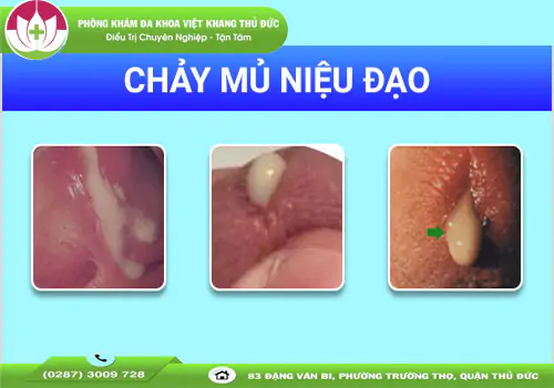 viem-nieu-dao-chay-mu-la-benh-gi-nguy-hiem-ra-sao-1586