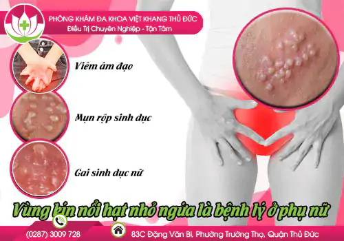 vung-kin-noi-hat-nho-ngua-la-benh-ly-o-phu-nu-635